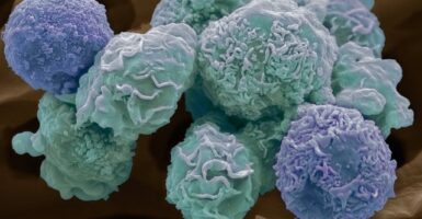cervical cancer cells