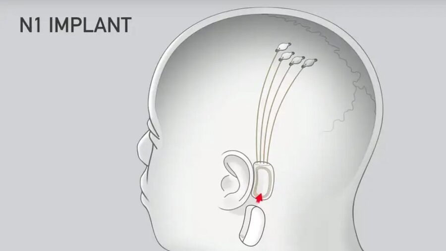 Neuralink